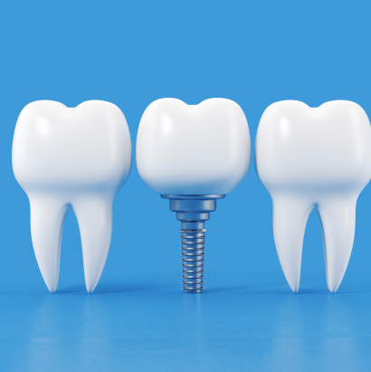 implantologia dentale